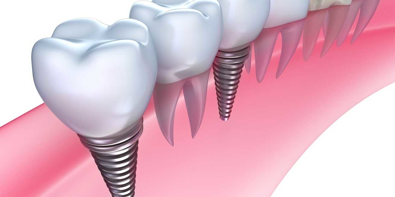 https://www.nkdental.in/img/slider/implant.jpg